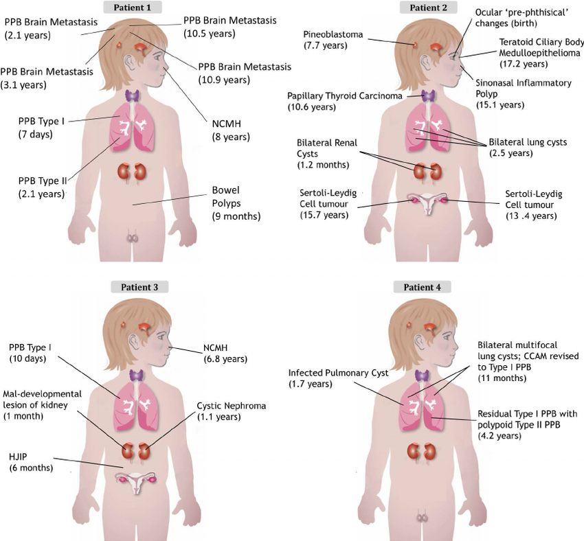 lung cancer in children