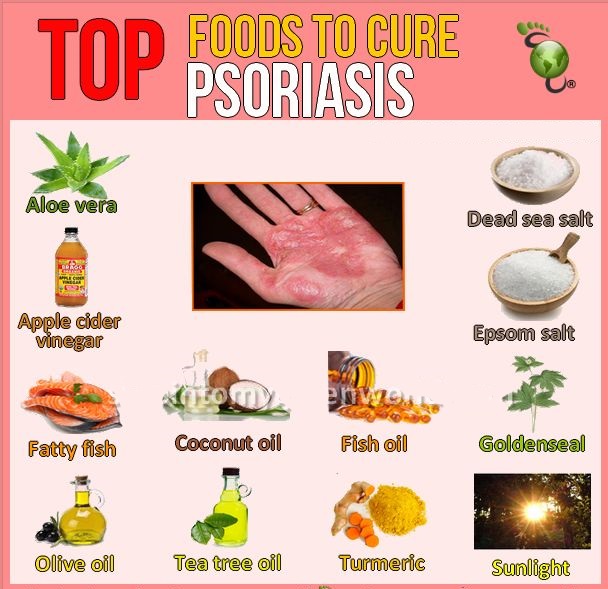 Aloe Vera for Psoriasis