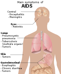 lung cancer in children