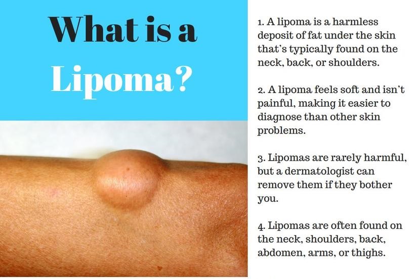 get rid of lipoma